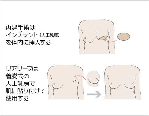 乳房再建術と人工乳房