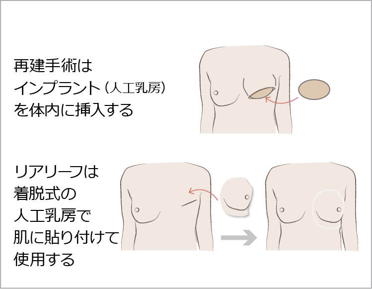 乳房再建術と人工乳房